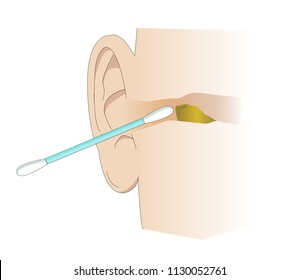 Illustration of the ear canal being cleaned with a cotton swab. Tool for cleaning wax and personal care of the ears. Removing cerumen of the ear.