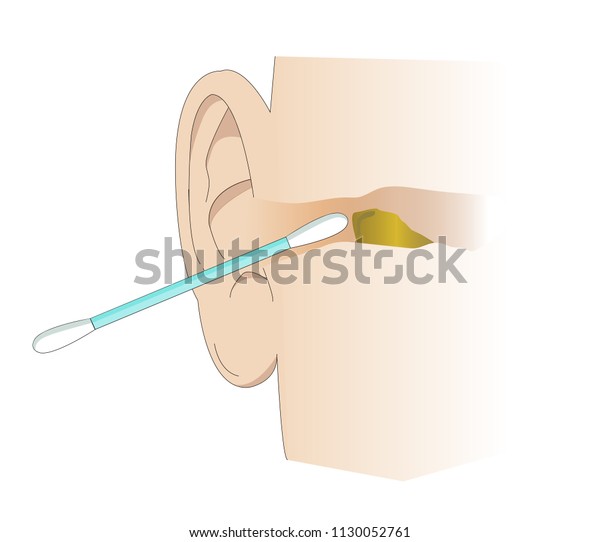 Illustration of the ear canal being cleaned with a\
cotton swab. Tool for cleaning wax and personal care of the ears.\
Removing cerumen of the\
ear.