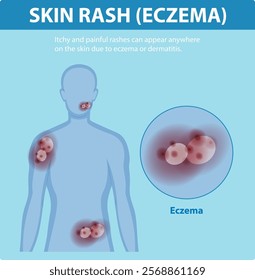 Illustration of eczema symptoms on human skin