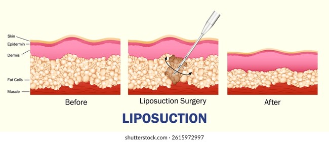 illustration of educational cutout diagram of human skin showing the process of Liposuction through lipo fat removal procedure. Healthcare and Medical concept