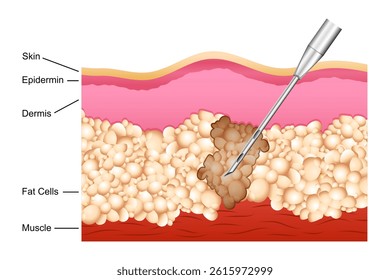 illustration of educational cutout diagram of human skin showing the process of Liposuction through lipo fat removal procedure. Healthcare and Medical concept