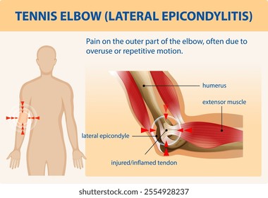 Illustration of elbow pain and muscle anatomy