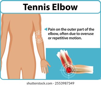 Illustration of elbow pain from repetitive motion