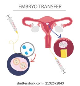 Illustration of Embryo transfer with embryon and uterus