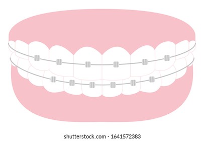 Illustration of esthetic dentistry and orthodontics: beautiful teeth arrangement and metal bracket