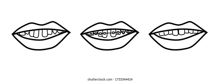 Illustration of esthetic dentistry and orthodontics. Braces teeth step illustration vector isolated on a white background. Distorted, beautiful tooth arrangement, with metal bracket. Doodle style.
