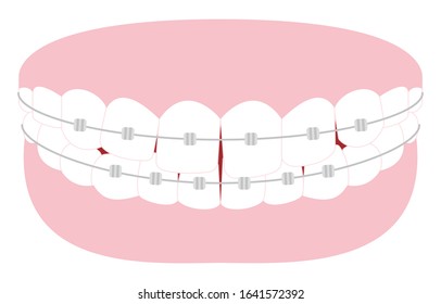 Illustration of esthetic dentistry and orthodontics: Distorted tooth arrangement and metal bracket