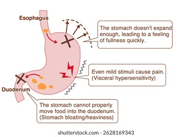 Ilustração explicando os sintomas e mecanismos da dispepsia funcional (FD)
