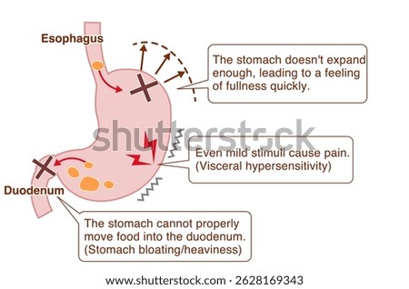 Illustration explaining the symptoms and mechanisms of Functional Dyspepsia (FD)
