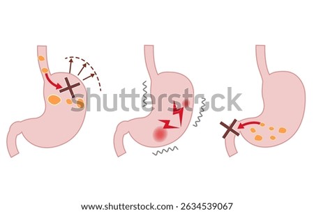 Illustration explaining the symptoms and mechanisms of Functional Dyspepsia (FD)