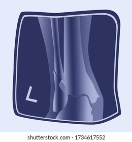 Illustration of external ankle fibula fracture on a X-ray.