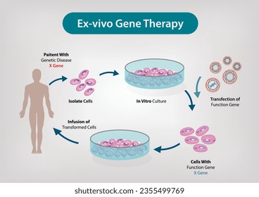 illustration of Ex-Vivo Gene Therapy - Ex vivo gene therapy involves the genetic modification of cells outside of the body to produce therapeutic factors and their subsequent transplantation back ...