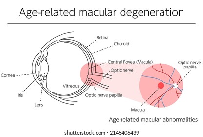 Illustration of eye disease, age-related macular degeneration