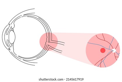 Illustration Of Eye Disease, Age-related Macular Degeneration