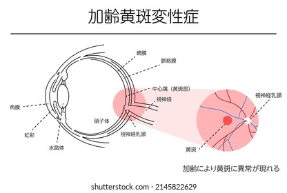 Illustration of eye disease, age-related macular degeneration - Translation: age-related macular abnormalities, cornea, iris, lens, vitreous, retina, choroid, central fossa (macula), optic nerve