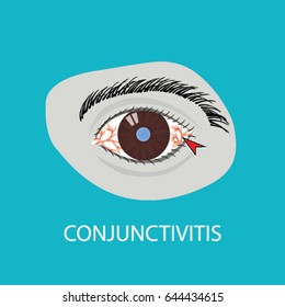 Illustration of the eye disease. conjunctivitis