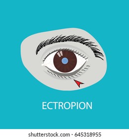 Illustration of the eye disease. ectropion