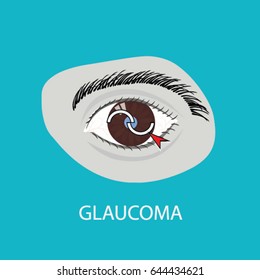 Illustration of the eye disease. glaucoma