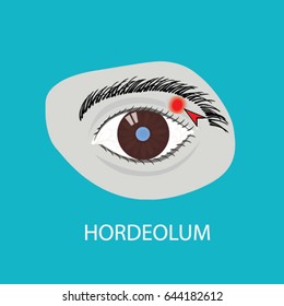 Illustration Of The Eye Disease. Hordeolum