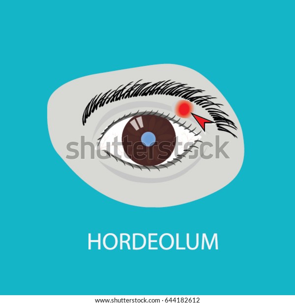 Illustration Eye Disease Hordeolum Stock Vector Royalty Free 644182612