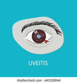 Illustration of the eye disease. uveitis
