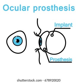 Illustration of an eye prosthesis in the style of a thin line. Front and side view of the ocular prosthesis. Scheme of the eye prosthesis with orbital implant.