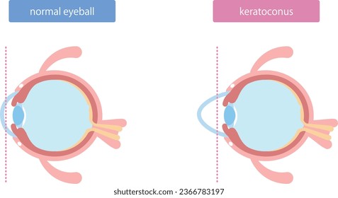 Illustration of eyeball abnormality, keratoconus
