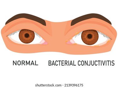 illustration of eyes with bacterial conjunctivitis. eye diseases. eye irritation. flat vector. healthy and diseased eye. isolated on white background. eyesight.