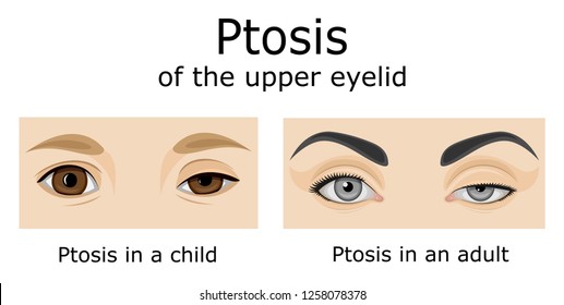 Illustration of the eyes of a child and an adult with symptoms of Ptosis of the upper eyelid