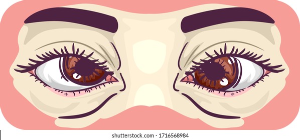 Illustration of Eyes Crossed or Esotropia