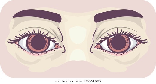 Illustration Of Eyes With Dilated Pupils, Symptom Of Mydriasis