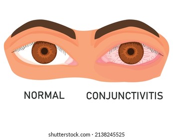 ilustración de ojos con irritación de membrana mucosa. ojos sanos y conjuntivitis. inflamación de la membrana mucosa del ojo. vector plano sobre fondo blanco