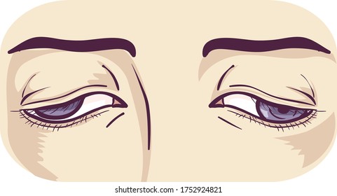 Illustration Of Eyes With Weakness In Muscle Holding The Eye In Place And Control Its Movement