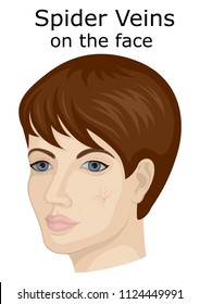 Illustration Of Facial Spider Veins On The Nose And Cheek Of A Woman