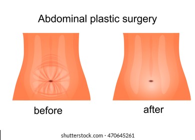 illustration of the female abdomen before and after abdominoplasty