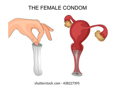 Female condom vagina nude Female condom vagina nude can suggest