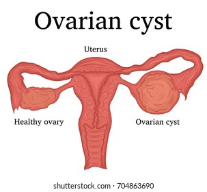 Illustration Of A Female Disease - Ovarian Cysts