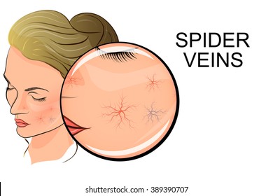 Illustration Of Female Face With Spider Veins