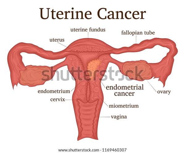 Illustration Female Reproductive System Disease Uterine Stock Vector Royalty Free 1169460307