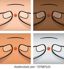 Illustration first aid of fingers squeezing an acne, ethnicities. Ideal for medical, informative and institutional catalogs