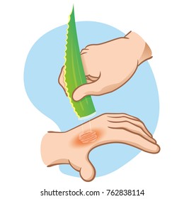 Illustration first aid hands with burn and injury, passing aloe vera, caucasian. Ideal for medical, informative and institutional catalogs