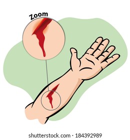 Illustration First Aid, Injured Arm With Bleeding Gash