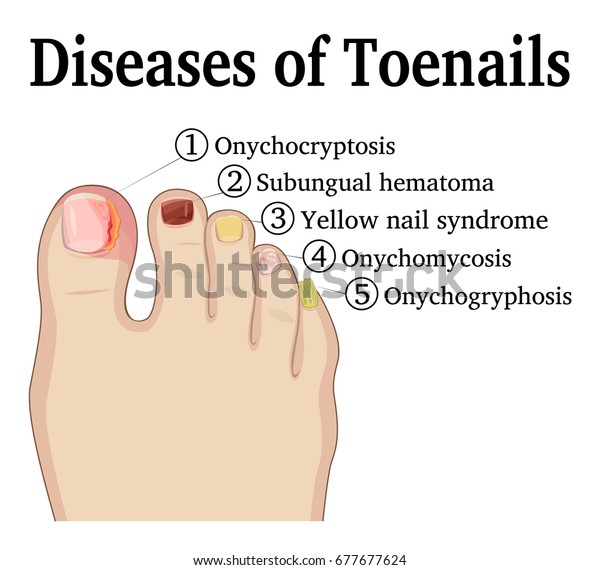爪の爪症 爪症 爪甲症 爪甲症 爪下血腫 黄色爪症など 爪の爪の5種類の爪の病気のイラスト のベクター画像素材 ロイヤリティフリー