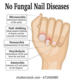 Nail Diseases Chart