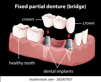 Illustration of a fixed partial denture