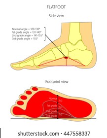 Illustration of flatfoot grade. Side view and bottom view (footprint).