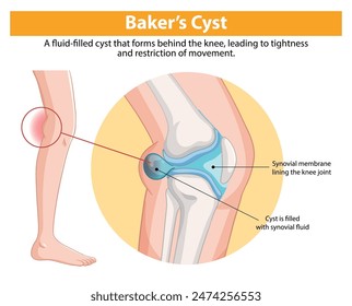 Illustration of a fluid-filled knee cyst