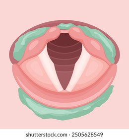 Illustration of food remaining on vocal cords during swallowing endoscopy_VE