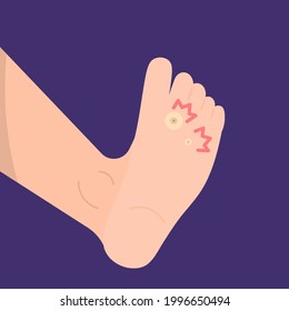 illustration of a foot affected by fish's eye disease or clavus. skin disease. pain or tenderness in the soles of the feet. flat cartoon style. vector design