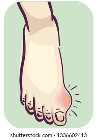 Illustration of a Foot with Lump Near Thumb. Gout Symptom